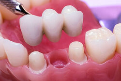 dental bridges