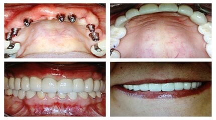 dental implants