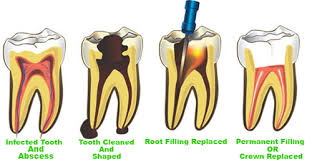 best root canal treatment