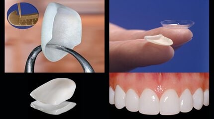 Porcelain Veneers